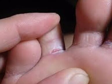 I got a toe fungus