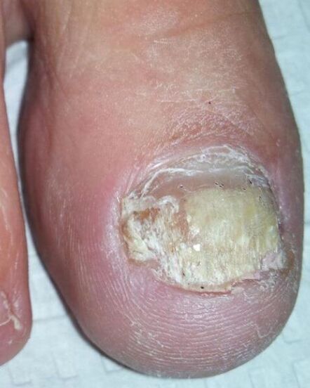 The fungus on the feet