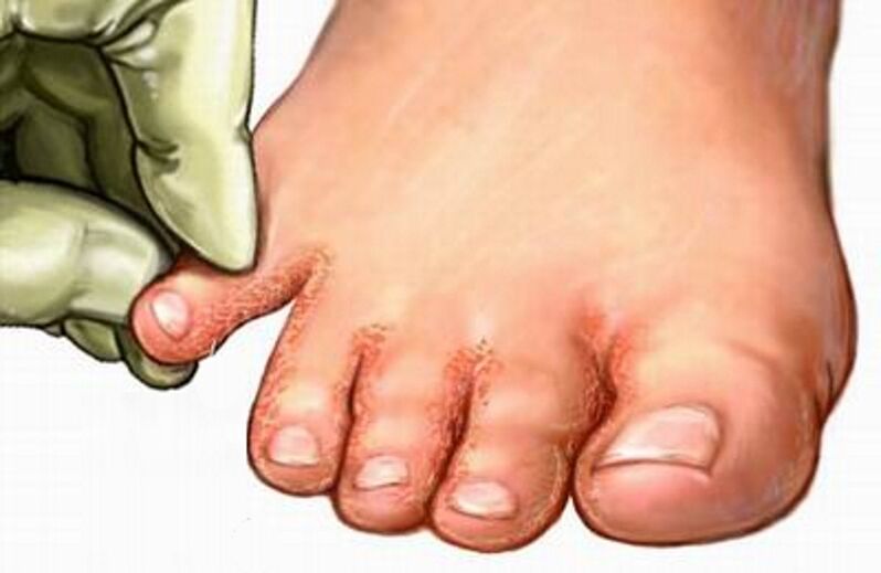 The fungus on the feet