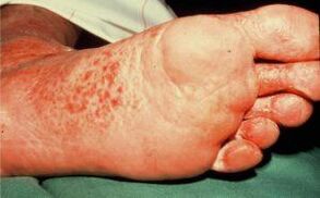 Fungus on foot with ulcers