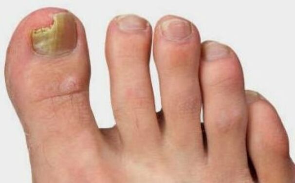 The fungus on the thumb of the foot