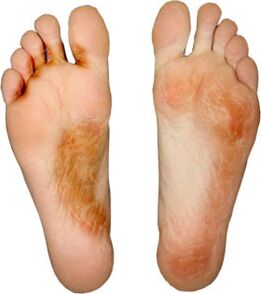 heal the fungus on the finger and don't lift it again