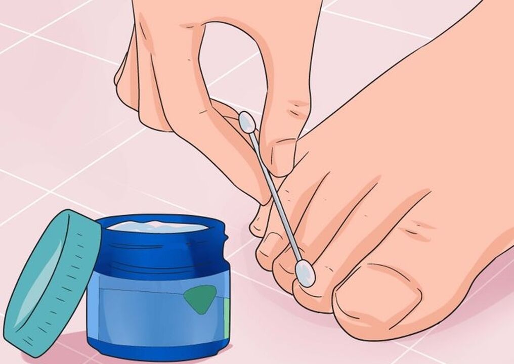 nail fungus treatment