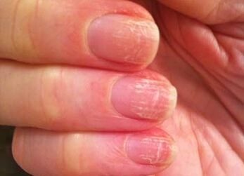 The initial stage of the fungus on the nails