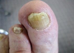 The causes of the appearance of the fungus on the nails