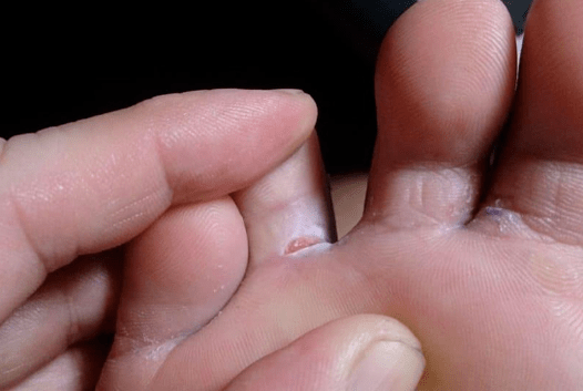 The appearance of bubble formations on the legs