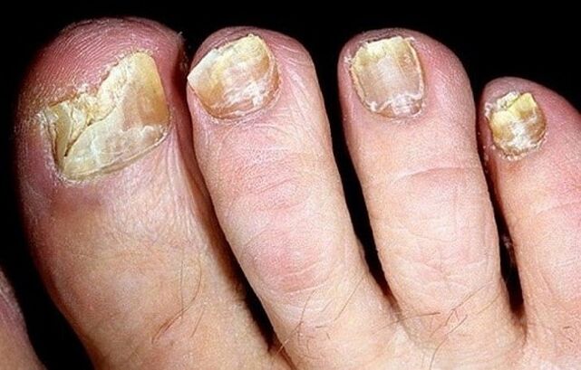 toenail fungus