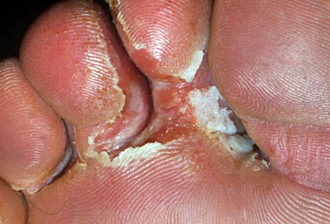 symptoms of ringworm