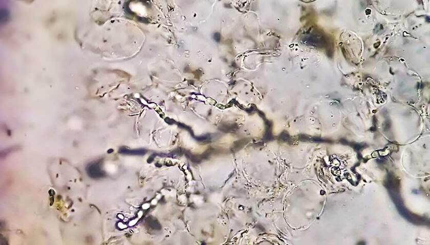 Fungi under the microscope - the culprit for the development of foot fungus