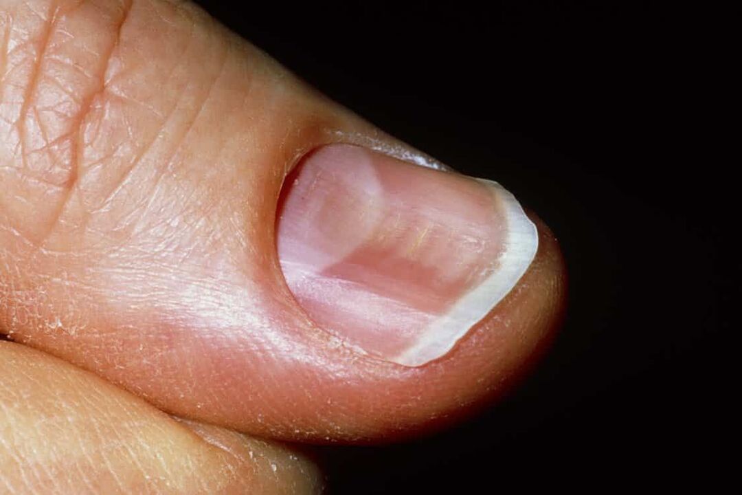 ingrown toenails