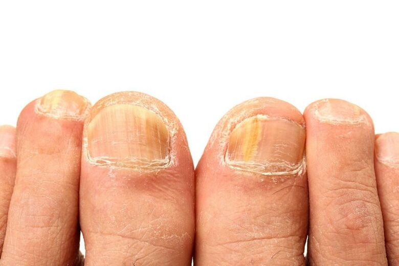 nail onychomycosis